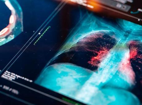 Sigara İçmeyenlerde Akciğer Kanseri Görülmesinin Sebepleri Neler?